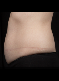 SculpSure-after-8 Houston Wellness & Aesthetics|Before and After Gallery