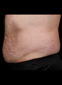 SculpSure-after-9 Houston Wellness & Aesthetics|Before and After Gallery