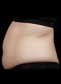 SculpSure-before-10 Houston Wellness & Aesthetics|Before and After Gallery