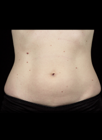 SculpSure-before-11 Houston Wellness & Aesthetics|Before and After Gallery