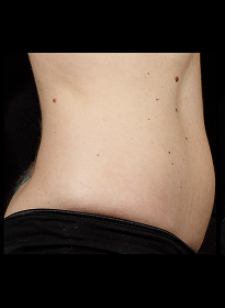 SculpSure-before-12 Houston Wellness & Aesthetics|Before and After Gallery