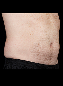 SculpSure-before-13 Houston Wellness & Aesthetics|Before and After Gallery