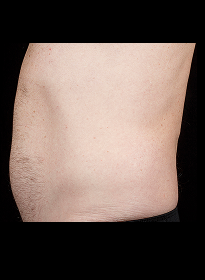 SculpSure-before-14 Houston Wellness & Aesthetics|Before and After Gallery
