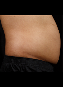 SculpSure-before-15 Houston Wellness & Aesthetics|Before and After Gallery