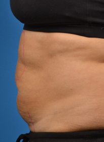 SculpSure-before-16 Houston Wellness & Aesthetics|Before and After Gallery