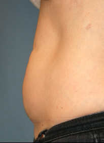 SculpSure-before-17 Houston Wellness & Aesthetics|Before and After Gallery