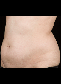 SculpSure-before-18 Houston Wellness & Aesthetics|Before and After Gallery