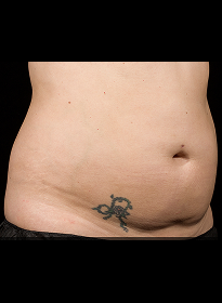 SculpSure-before-19 Houston Wellness & Aesthetics|Before and After Gallery