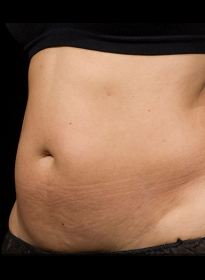 SculpSure-before-20 Houston Wellness & Aesthetics|Before and After Gallery