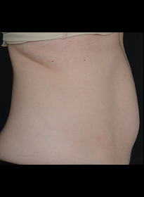 SculpSure-before-21 Houston Wellness & Aesthetics|Before and After Gallery