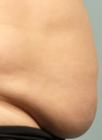 SculpSure-before-22 Houston Wellness & Aesthetics|Before and After Gallery