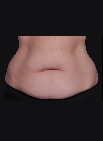 SculpSure-before-23 Houston Wellness & Aesthetics|Before and After Gallery