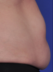 SculpSure-before-24 Houston Wellness & Aesthetics|Before and After Gallery