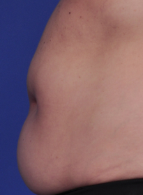 SculpSure-before-25 Houston Wellness & Aesthetics|Before and After Gallery