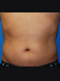 SculpSure-before-26 Houston Wellness & Aesthetics|Before and After Gallery