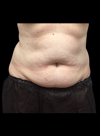 SculpSure-before-27 Houston Wellness & Aesthetics|Before and After Gallery
