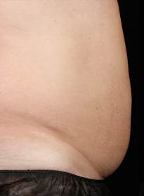 SculpSure-before-28 Houston Wellness & Aesthetics|Before and After Gallery