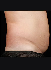 SculpSure-before-29 Houston Wellness & Aesthetics|Before and After Gallery
