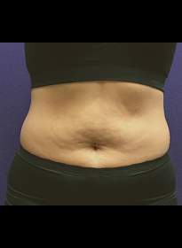 SculpSure-before-30 Houston Wellness & Aesthetics|Before and After Gallery