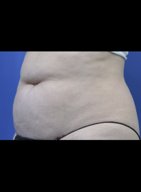SculpSure-before-31 Houston Wellness & Aesthetics|Before and After Gallery