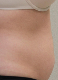 SculpSure-before-32 Houston Wellness & Aesthetics|Before and After Gallery