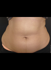 SculpSure-before-33 Houston Wellness & Aesthetics|Before and After Gallery