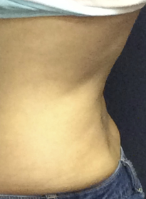 SculpSure-before-35 Houston Wellness & Aesthetics|Before and After Gallery