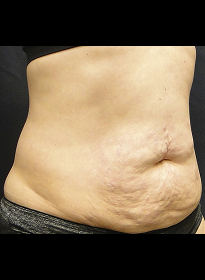 SculpSure-before-36 Houston Wellness & Aesthetics|Before and After Gallery