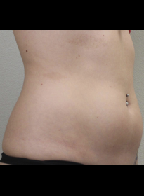 SculpSure-before-37 Houston Wellness & Aesthetics|Before and After Gallery