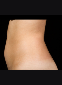 SculpSure-before-38 Houston Wellness & Aesthetics|Before and After Gallery