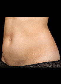 SculpSure-before-39 Houston Wellness & Aesthetics|Before and After Gallery