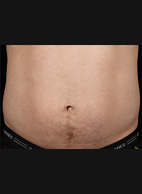 SculpSure-before-4 Houston Wellness & Aesthetics|Before and After Gallery