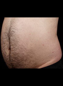 SculpSure-before-40 Houston Wellness & Aesthetics|Before and After Gallery