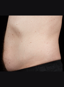 SculpSure-before-41 Houston Wellness & Aesthetics|Before and After Gallery