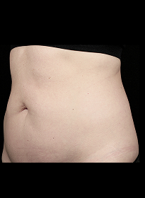 SculpSure-before-42 Houston Wellness & Aesthetics|Before and After Gallery