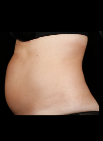 SculpSure-before-43 Houston Wellness & Aesthetics|Before and After Gallery
