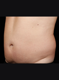 SculpSure-before-44 Houston Wellness & Aesthetics|Before and After Gallery