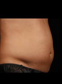 SculpSure-before-45 Houston Wellness & Aesthetics|Before and After Gallery