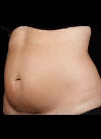 SculpSure-before-46 Houston Wellness & Aesthetics|Before and After Gallery