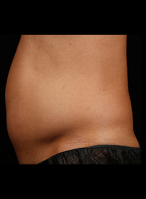 SculpSure-before-48 Houston Wellness & Aesthetics|Before and After Gallery