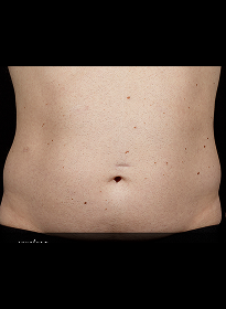 SculpSure-before-5 Houston Wellness & Aesthetics|Before and After Gallery