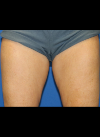 SculpSure-before-50 Houston Wellness & Aesthetics|Before and After Gallery