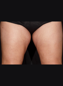 SculpSure-before-51 Houston Wellness & Aesthetics|Before and After Gallery