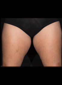 SculpSure-before-53 Houston Wellness & Aesthetics|Before and After Gallery