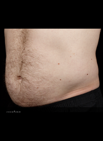 SculpSure-before-6 Houston Wellness & Aesthetics|Before and After Gallery