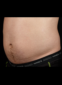 SculpSure-before-7 Houston Wellness & Aesthetics|Before and After Gallery