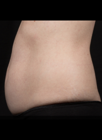 SculpSure-before-8 Houston Wellness & Aesthetics|Before and After Gallery