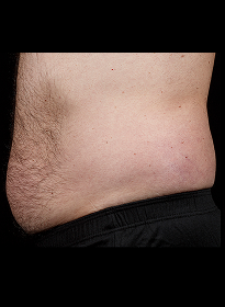 SculpSure-before-9 Houston Wellness & Aesthetics|Before and After Gallery