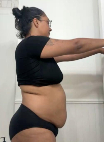 SculpSure-before Houston Wellness & Aesthetics|Before and After Gallery