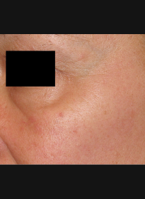 Skin-Renewal-after-2 Houston Wellness & Aesthetics|Before and After Gallery